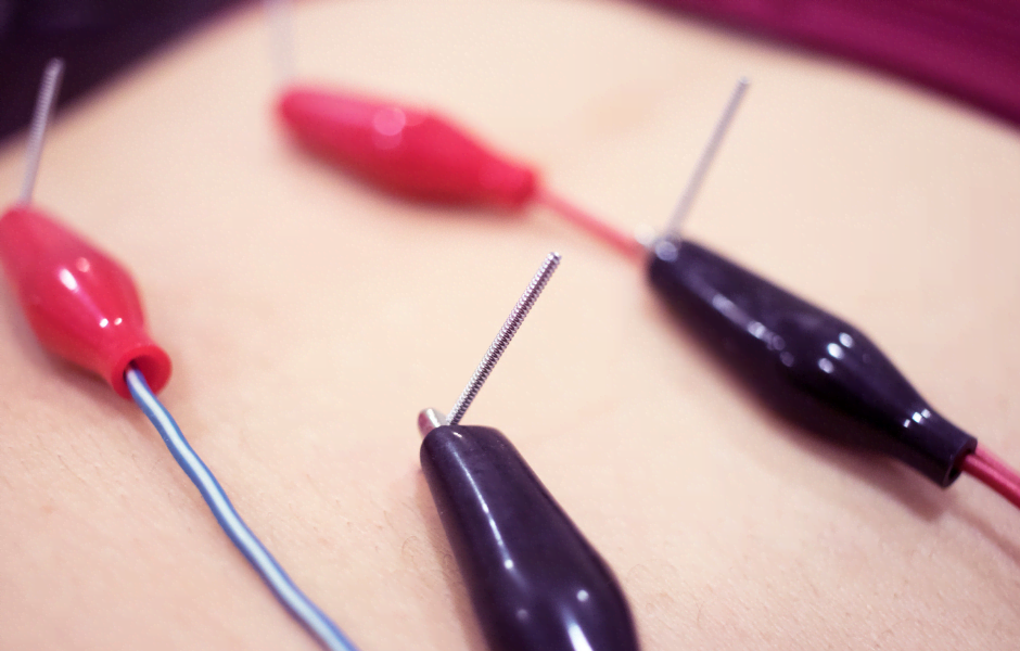 Dry Needling