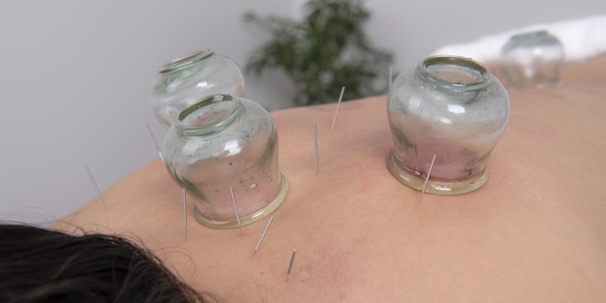 Dry needling and Cupping therapy