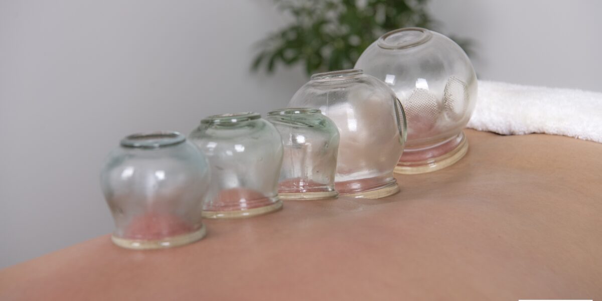 Cupping Therapy